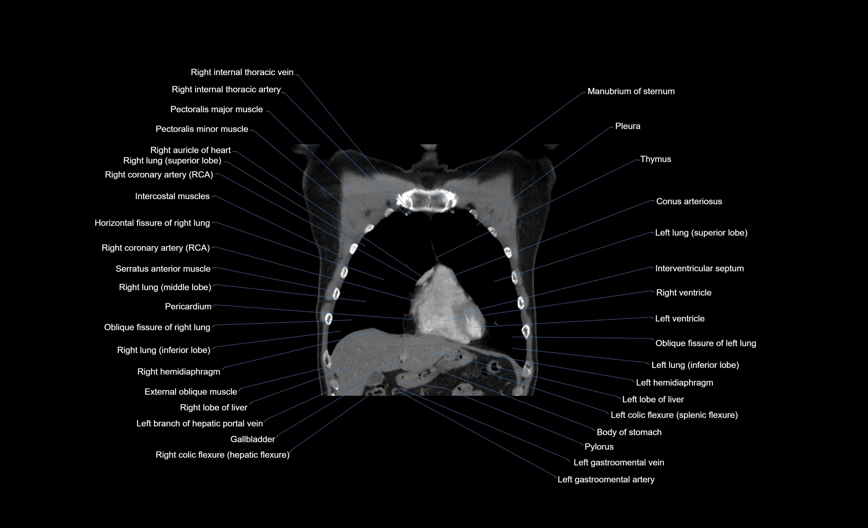 CT chest (thorax) soft tissue window labelled coronal cross sectional anatomy radiology image-00087.webp